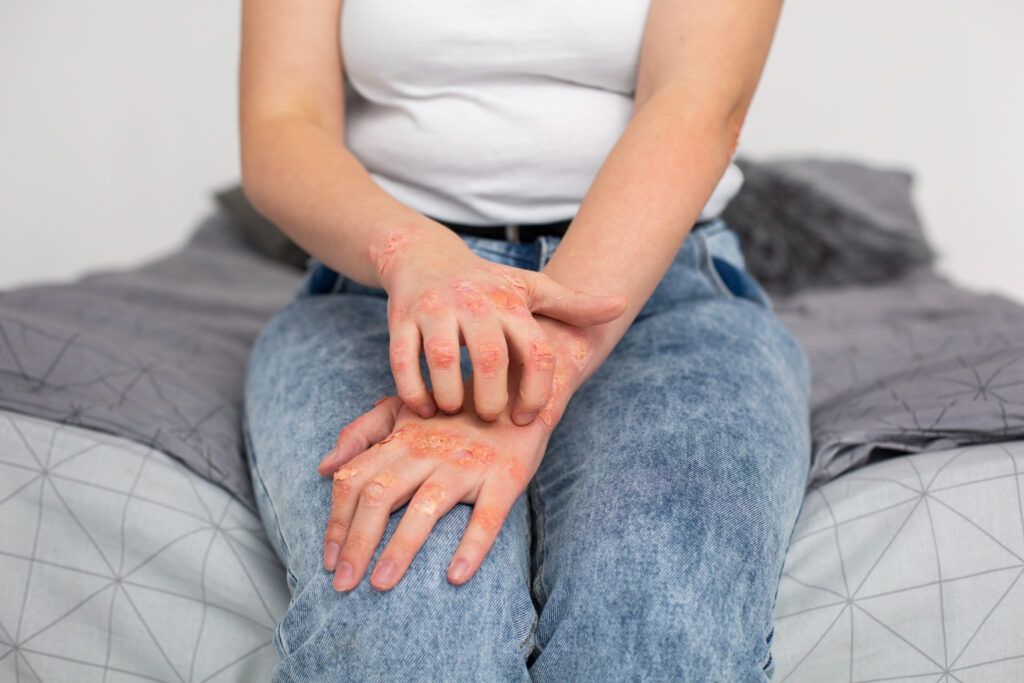 dermatita-seboreica-tratament-naturist-7